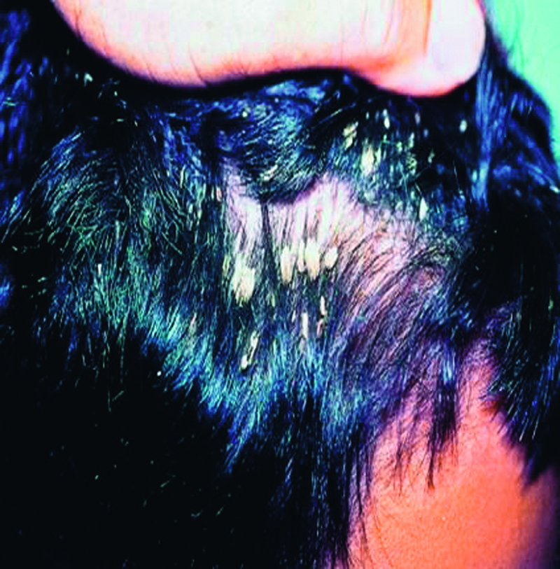 Si on peut le sucre au psoriasis