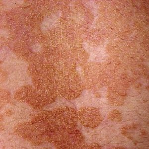 Tinea versicolor - Mediket